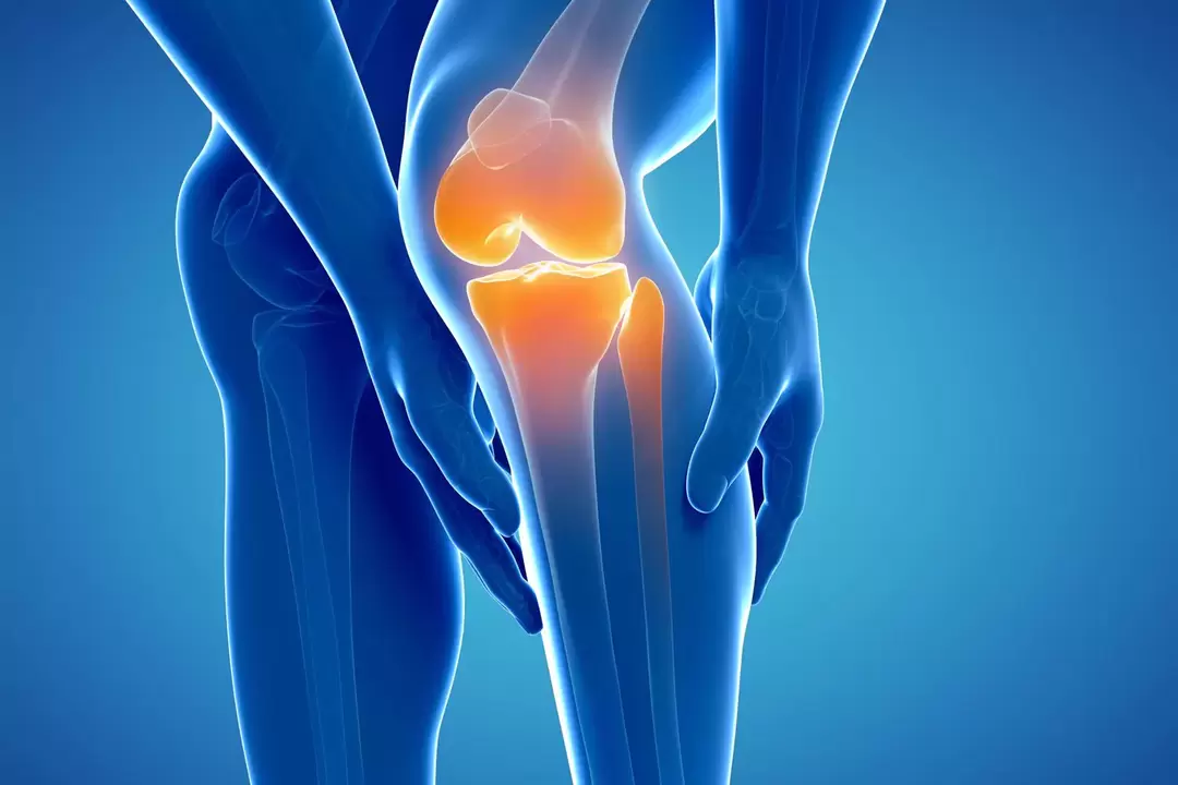 Артроза коленског зглоба (гонартроза, деформирајући остеоартритис)